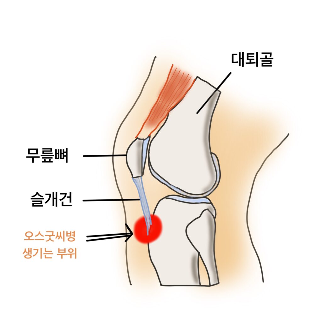 오스굿씨병 호발위치