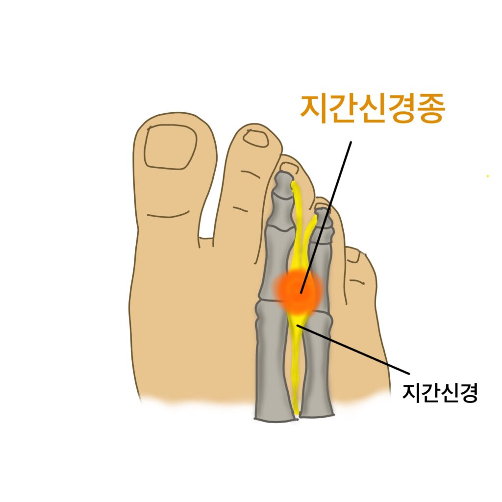 지간신경종구조